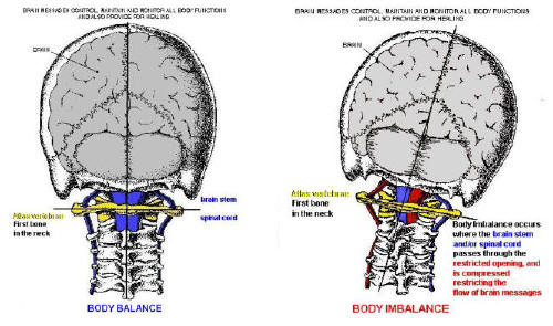 West Hollywood Atlas Subluxation